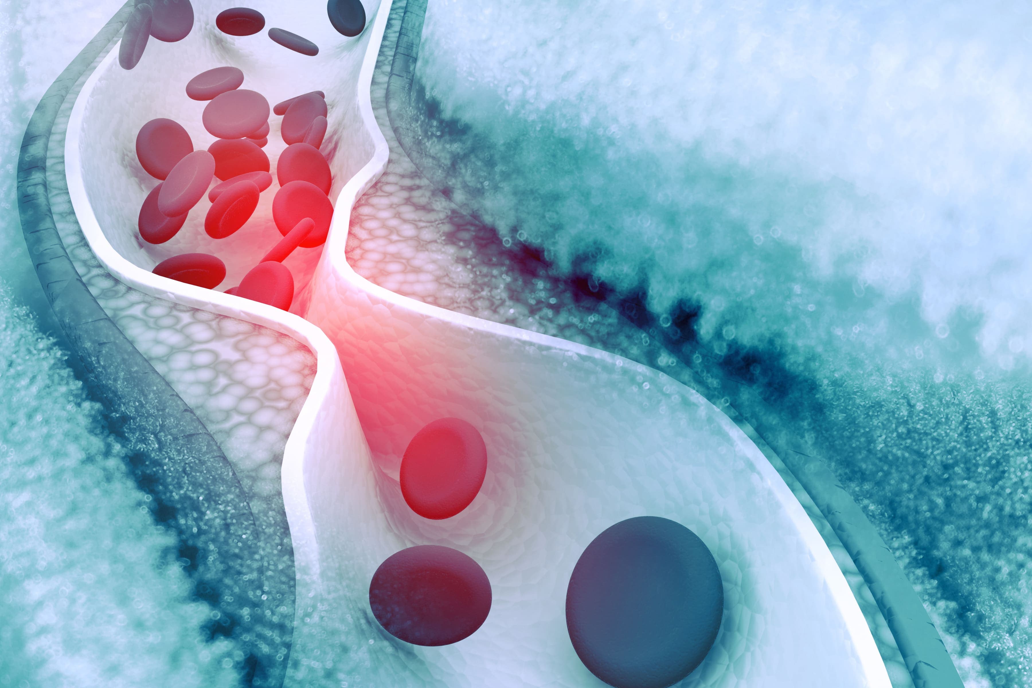 Dislipidemia