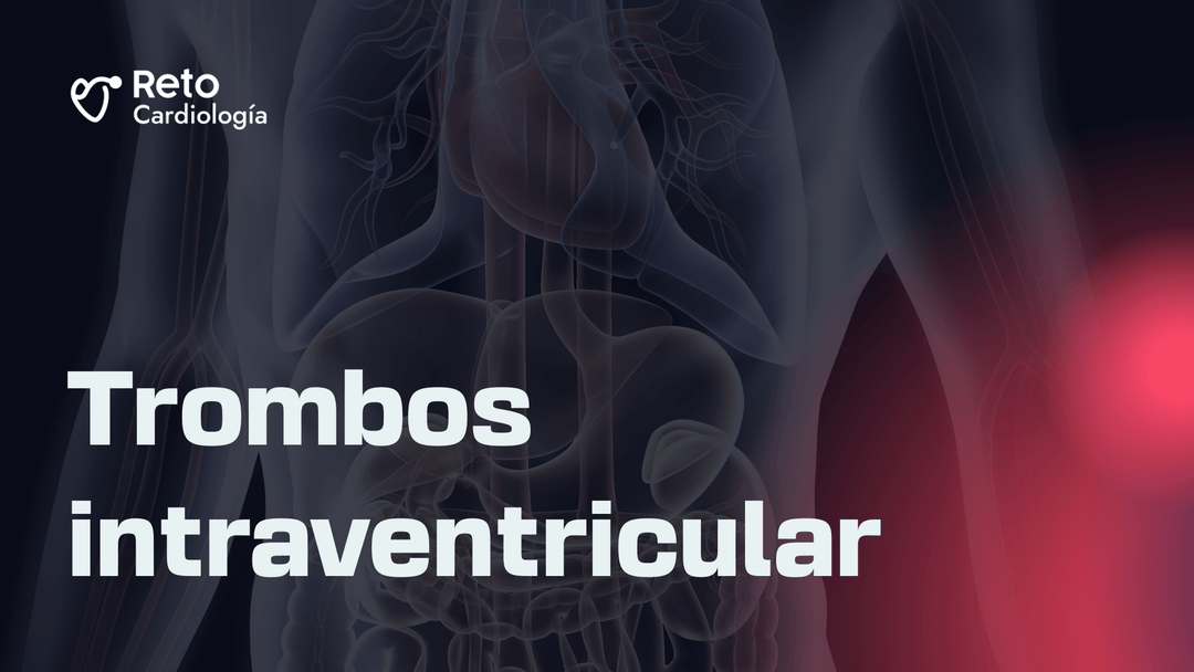Podemos hacer algo para prevenir trombos intraventriculares en pacientes
